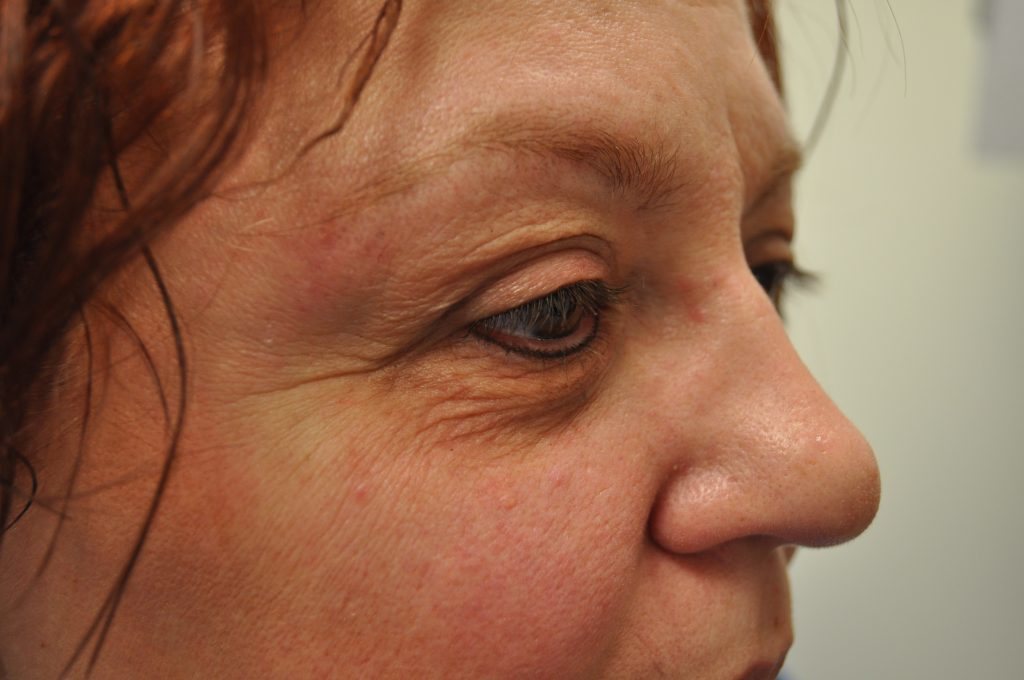 Close-up of a woman's eye area with visible wrinkles and fine lines.