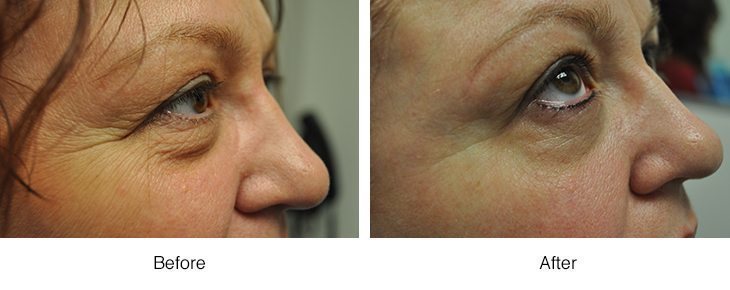 Before and after comparison of nose and cheek skin texture.