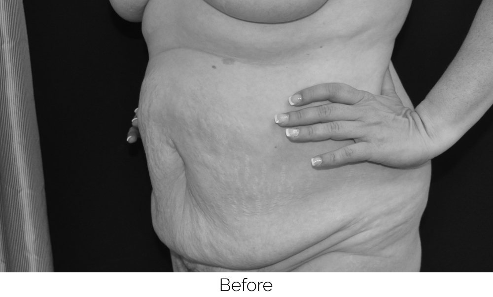 Close-up of a woman's abdomen with loose skin before treatment.