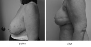 Side-by-side before and after photos showing arm and breast changes.