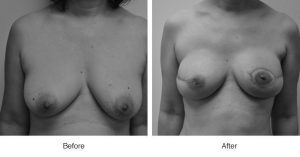 Before and after photos of breast surgery showing changes in shape and symmetry.