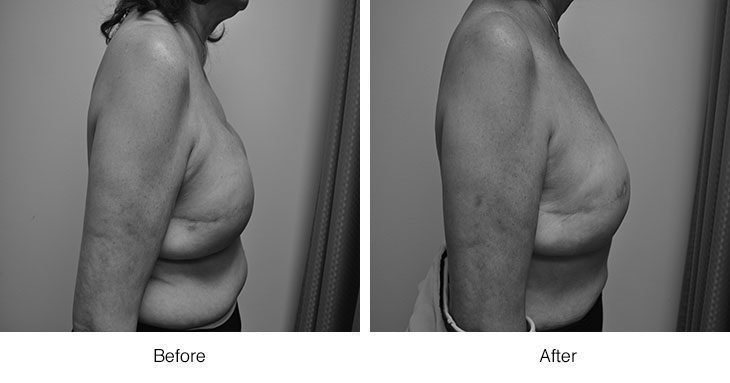 Before and after images showing significant arm fat reduction.